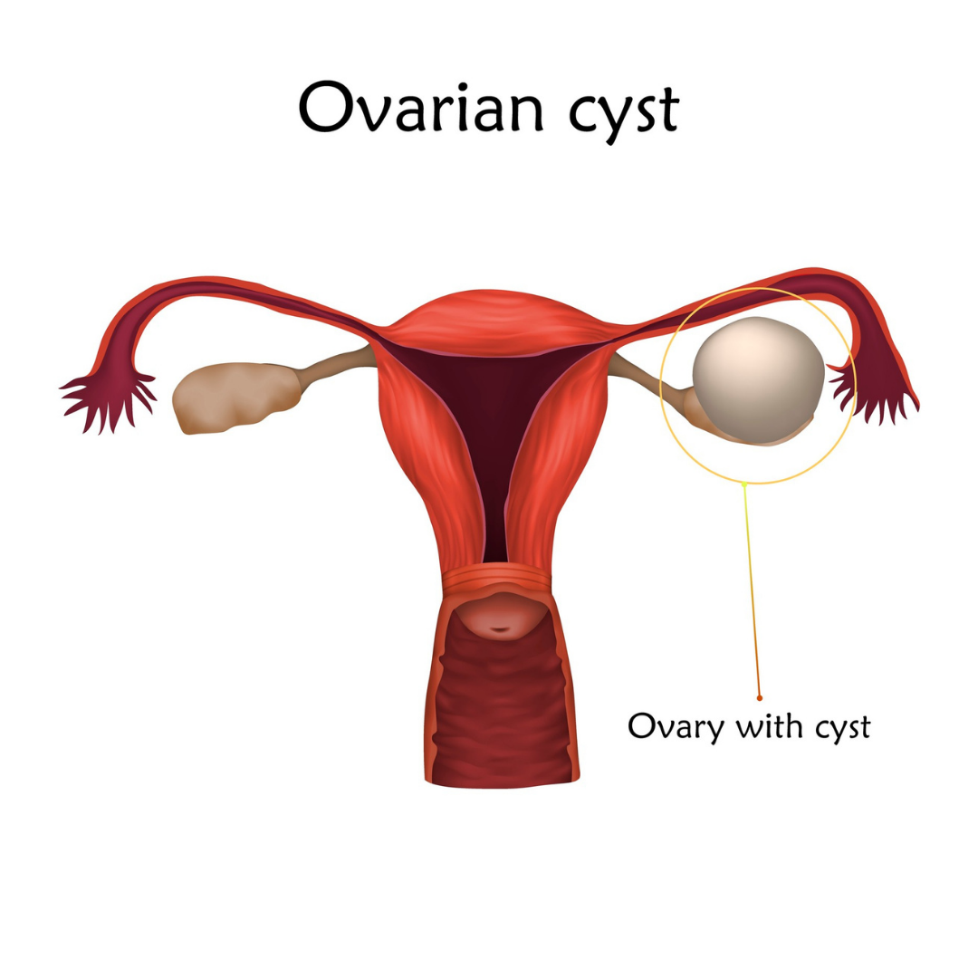 Ovarian Cysts Symptoms Causes And Diagnosis Health Solution Centre